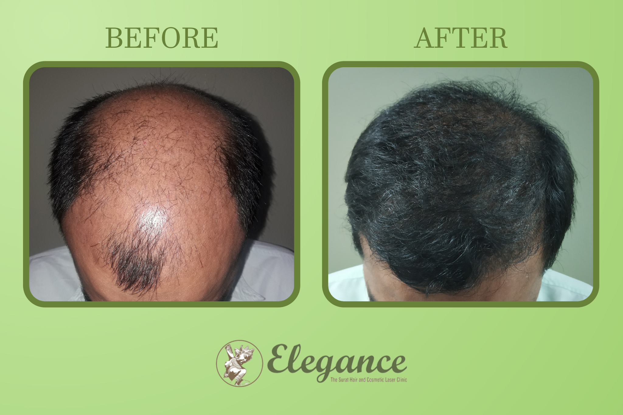 Male Hair Transplant in Hadapsar Pune, Maharashtra, India