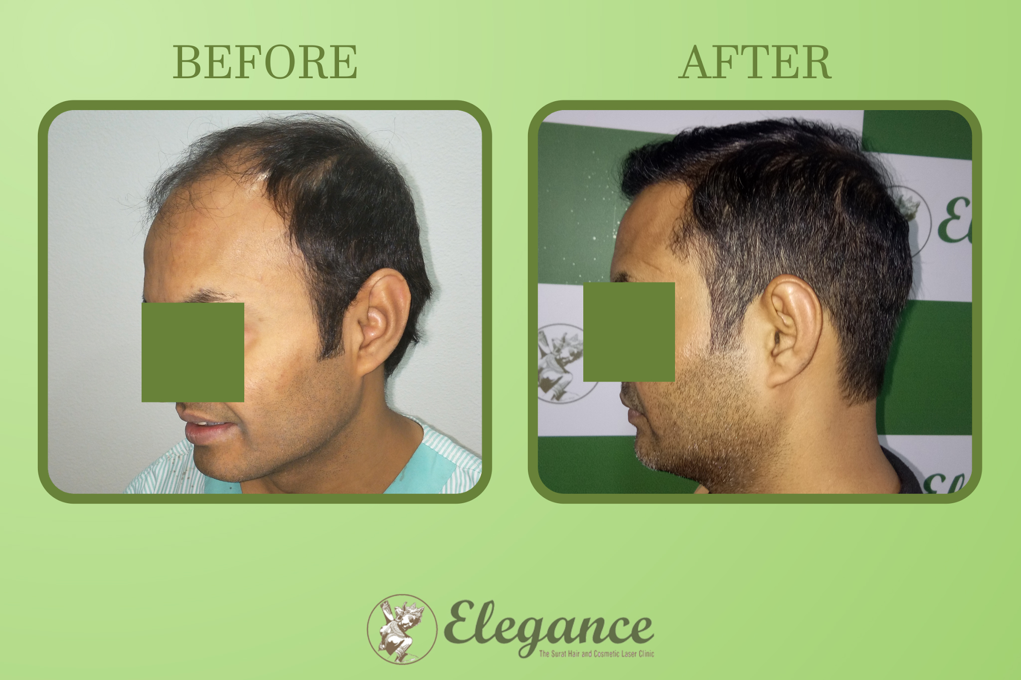 Male Hair Transplant in Navsari, Gujarat, India