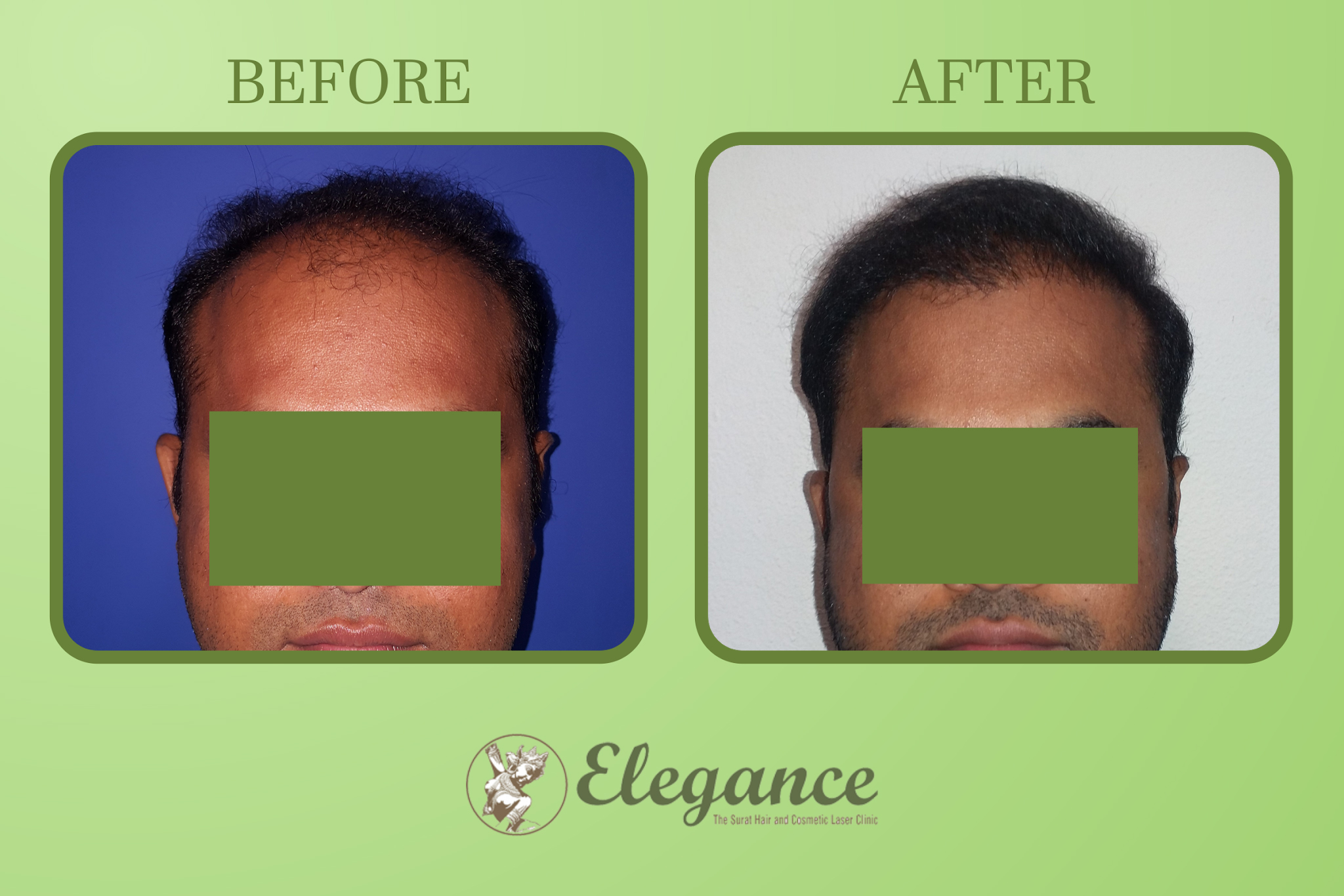 Male Hair Transplant in Surat, Gujarat, India