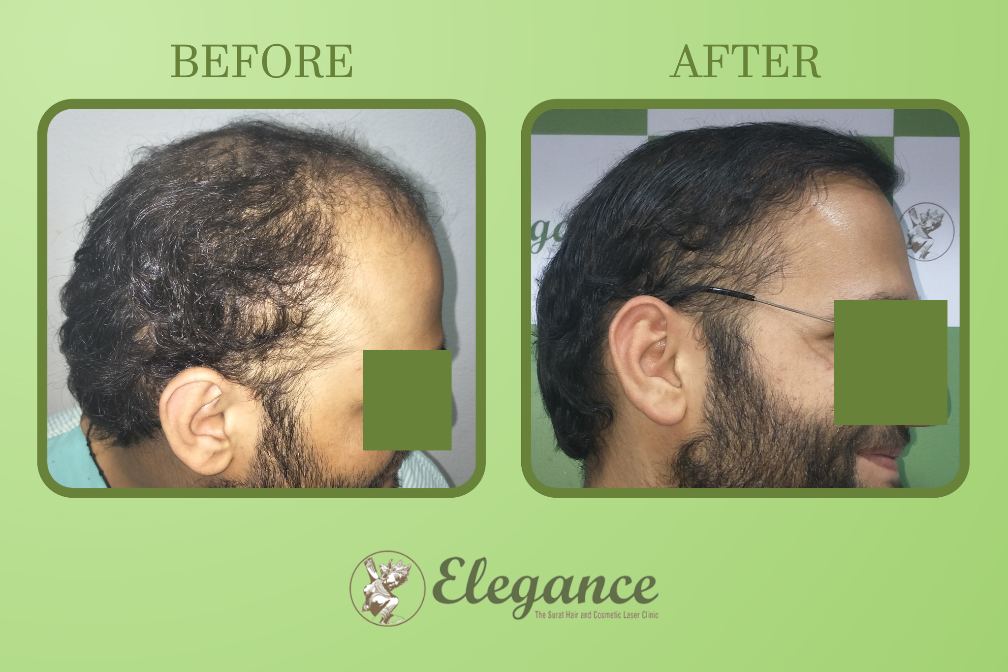 Man Hair Transplant in Amreli, Gujarat, India