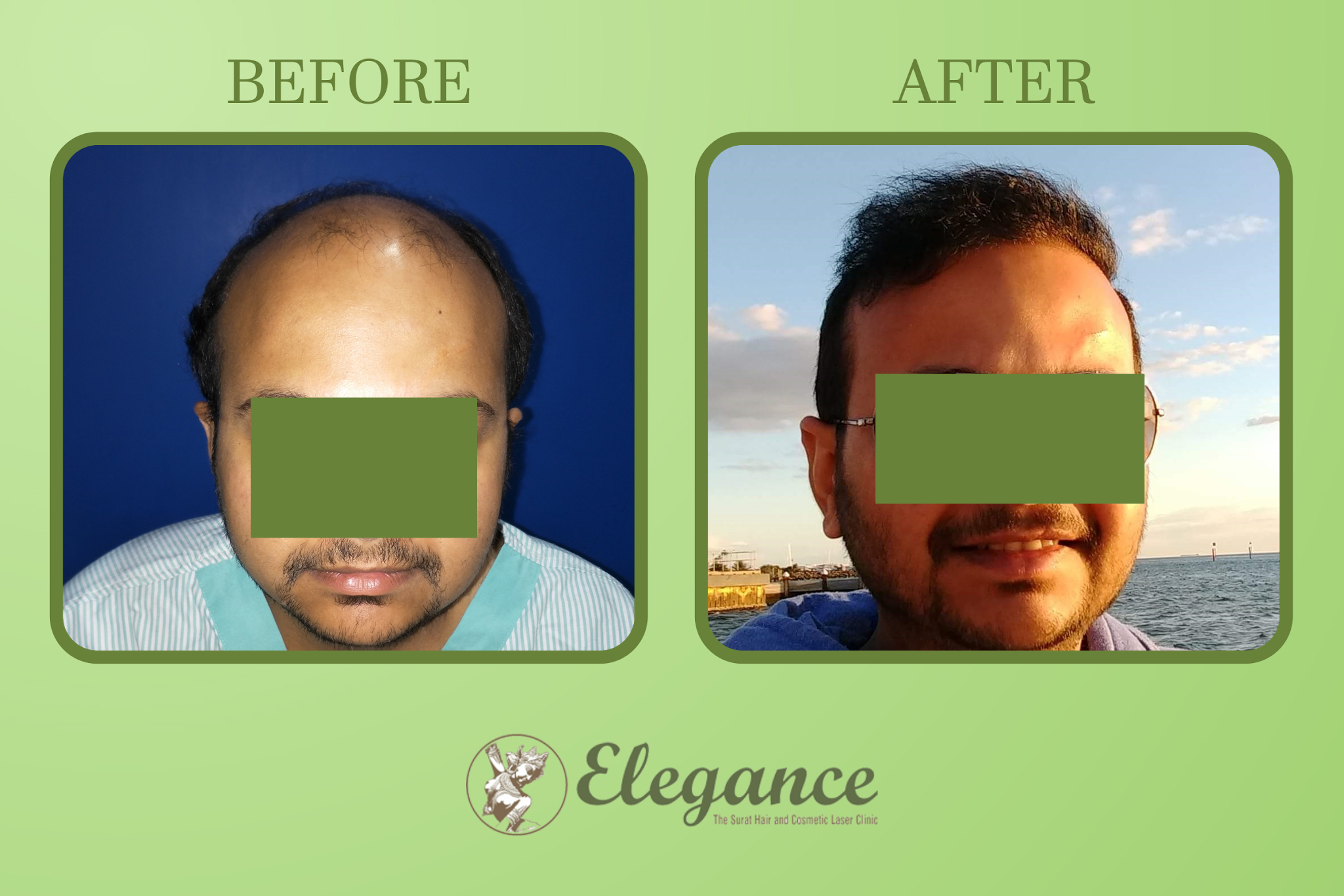 Man Hair Transplant in Anand, Gujarat, India