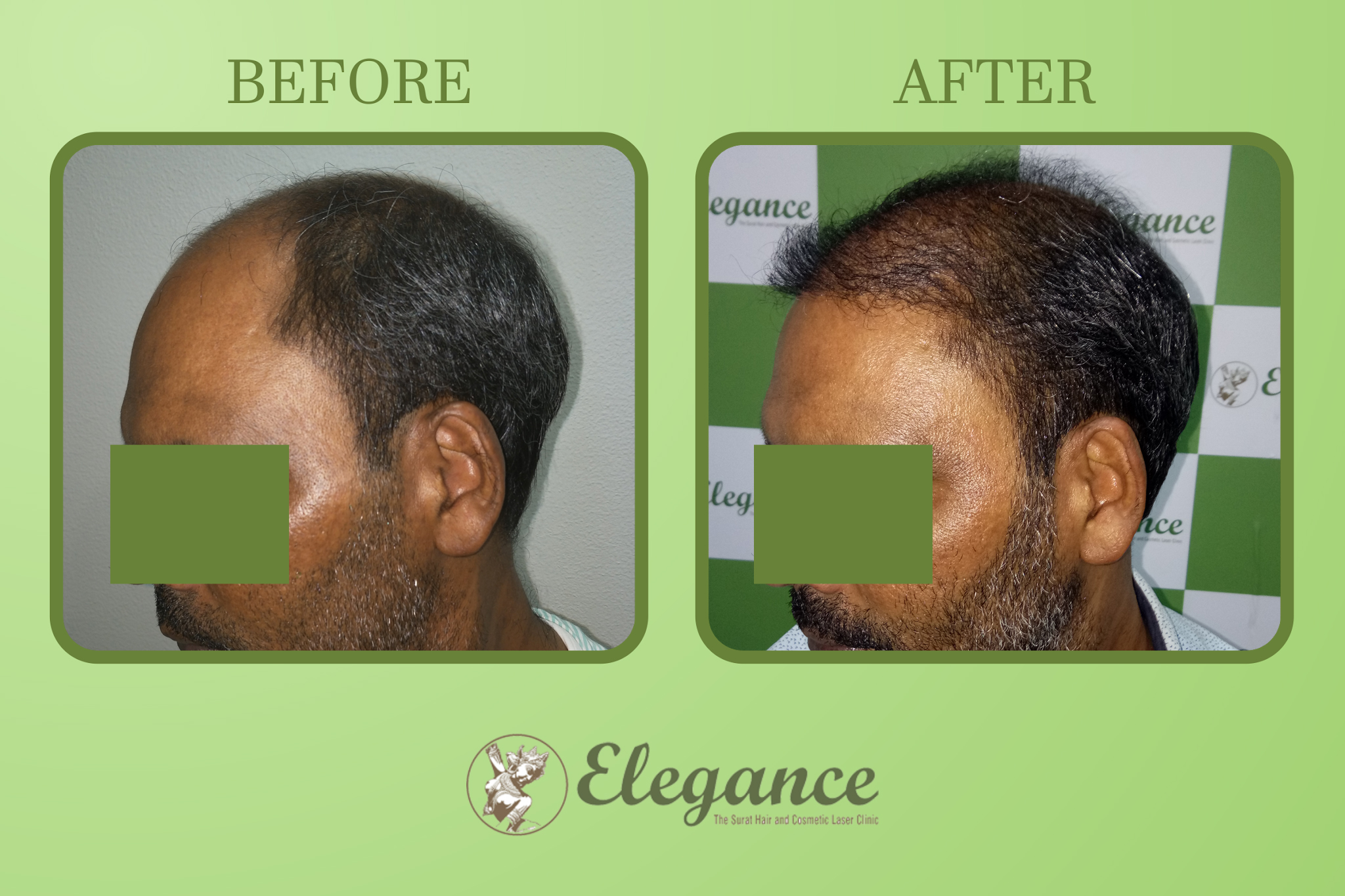 Man Hair Transplant in Bharuch, Gujarat, India