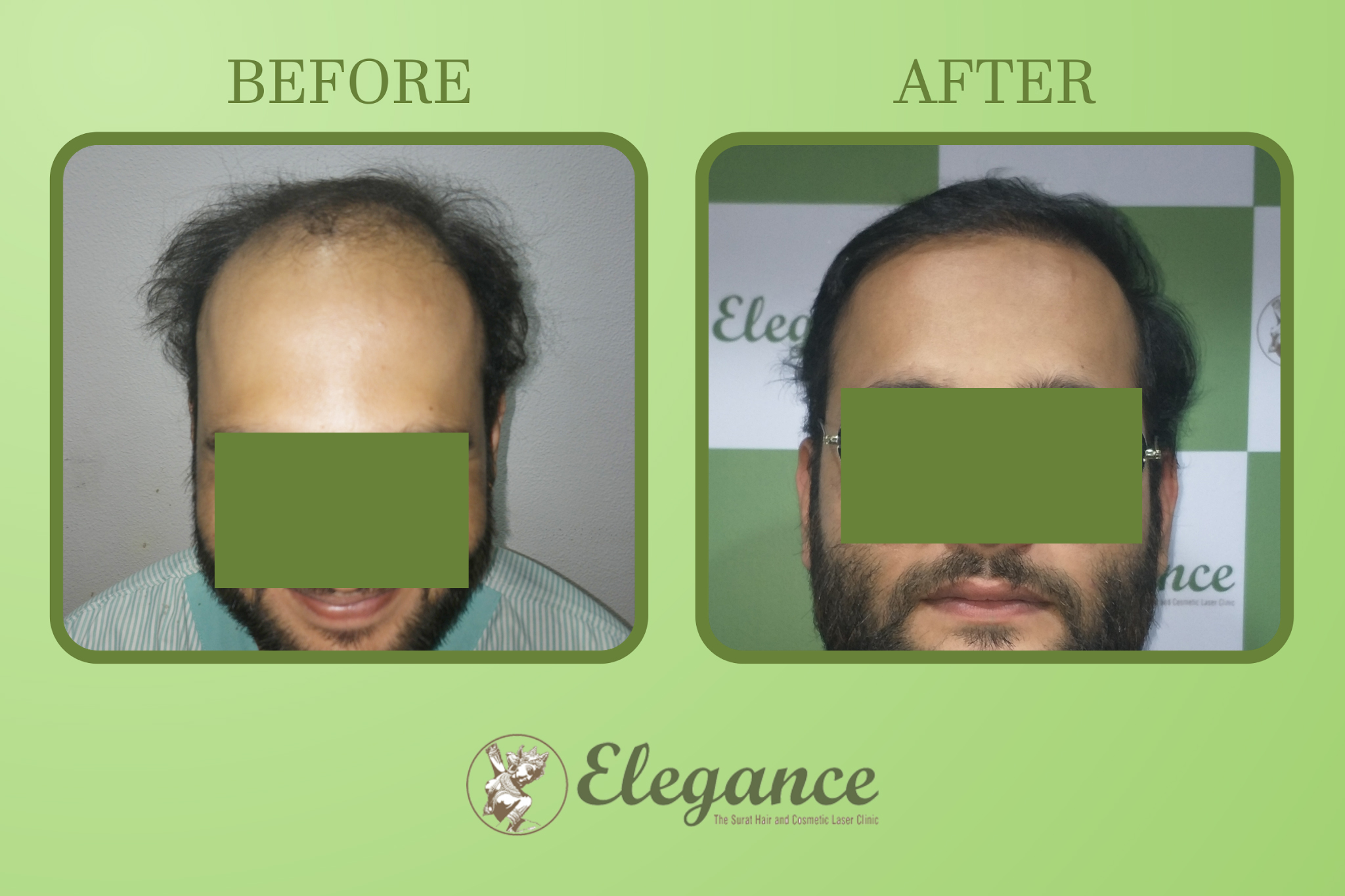 Man Hair Transplant in Bhavnagar, Gujarat, India