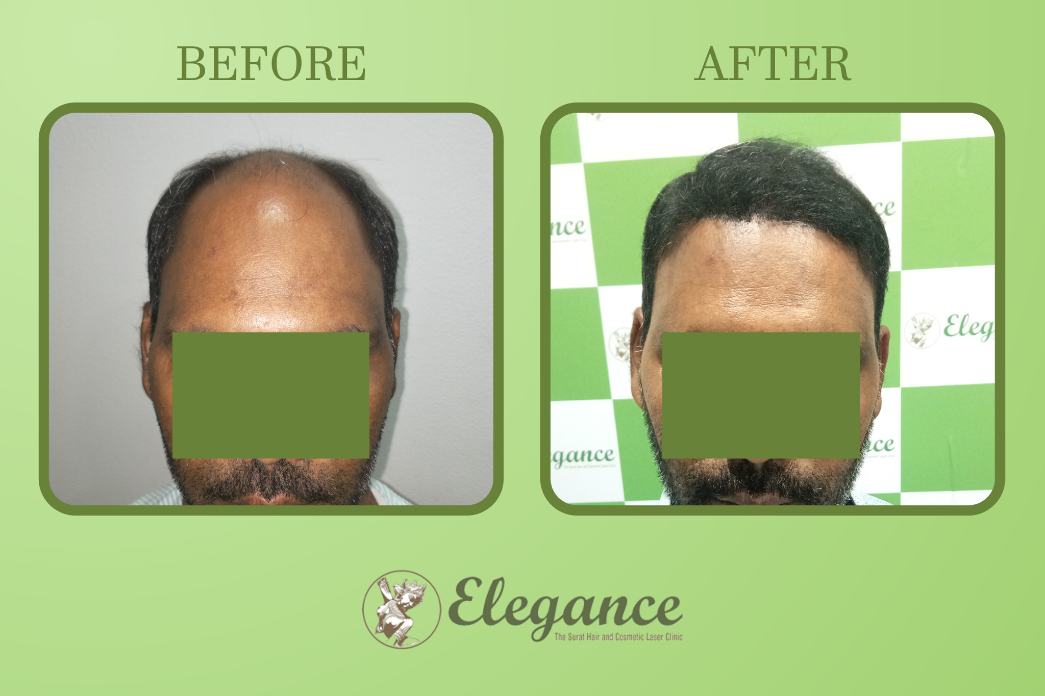 Man Hair Transplant in Dahod, Gujarat, India