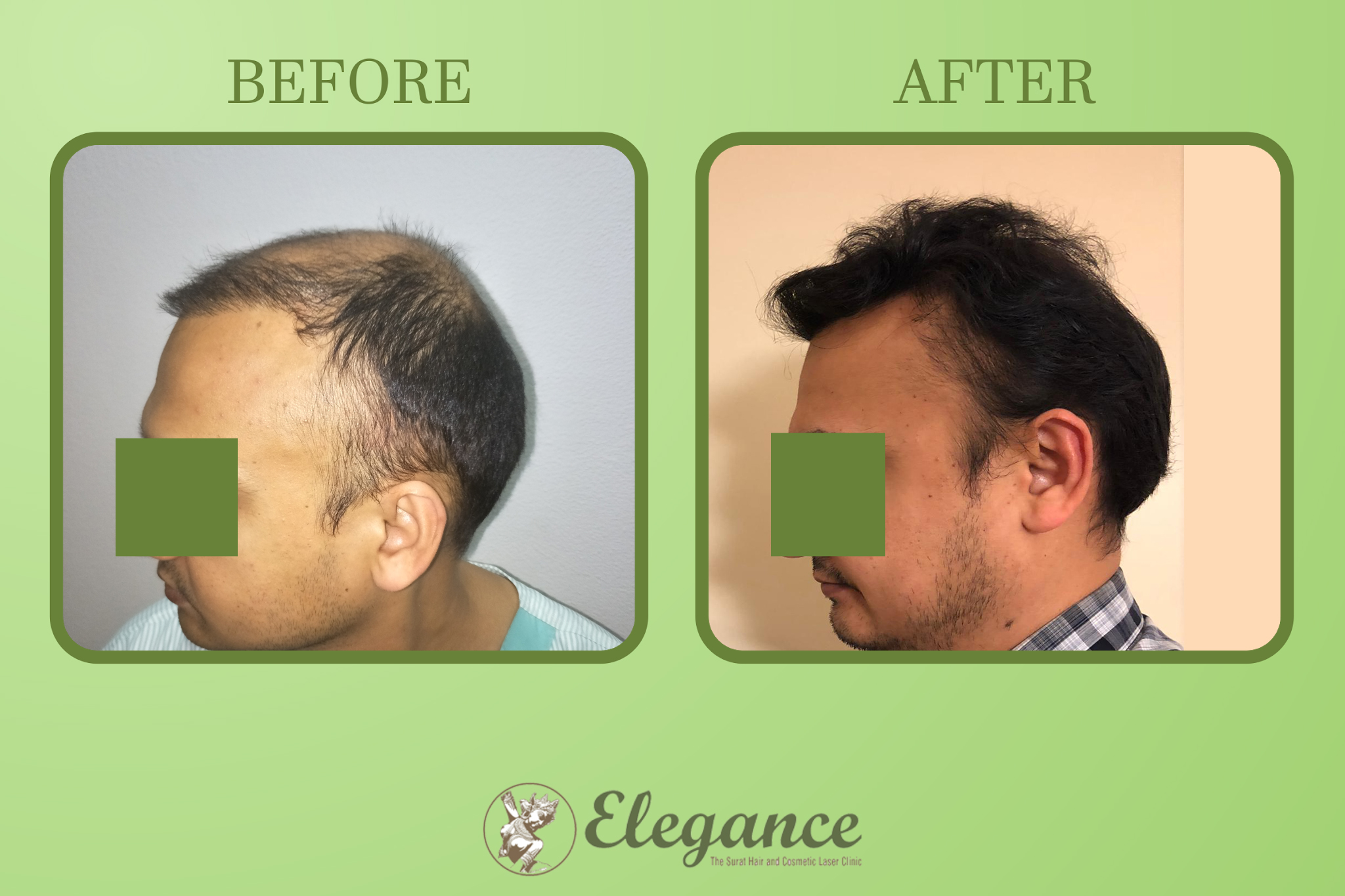 Man Hair Transplant in Gandhinagar, Gujarat, India
