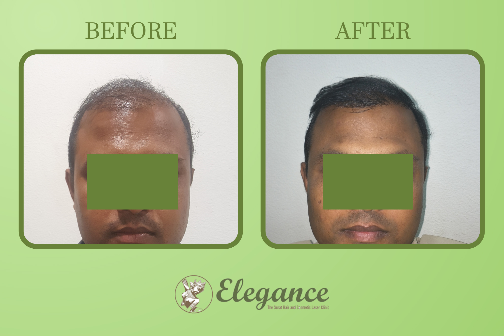 Man Hair Transplant in Navsari, Gujarat, India
