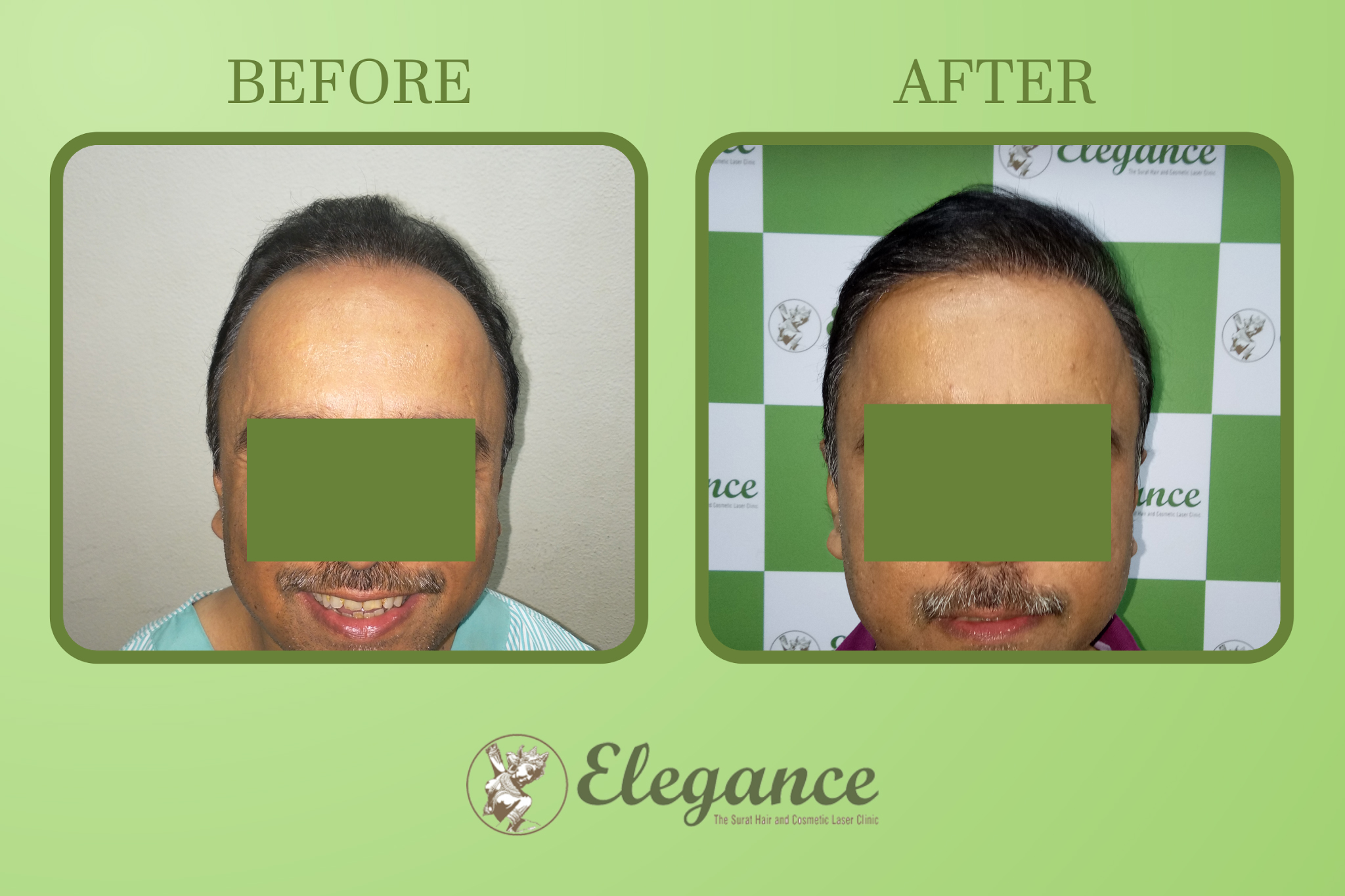 Man Hair Transplant in Surat, Gujarat, India