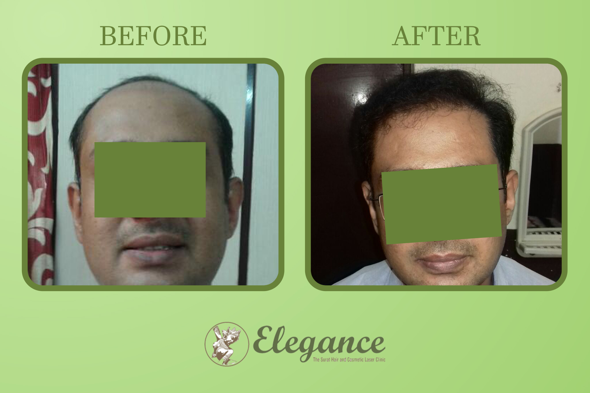 Men hair Transplant in Adajan, Surat, Gujarat, India