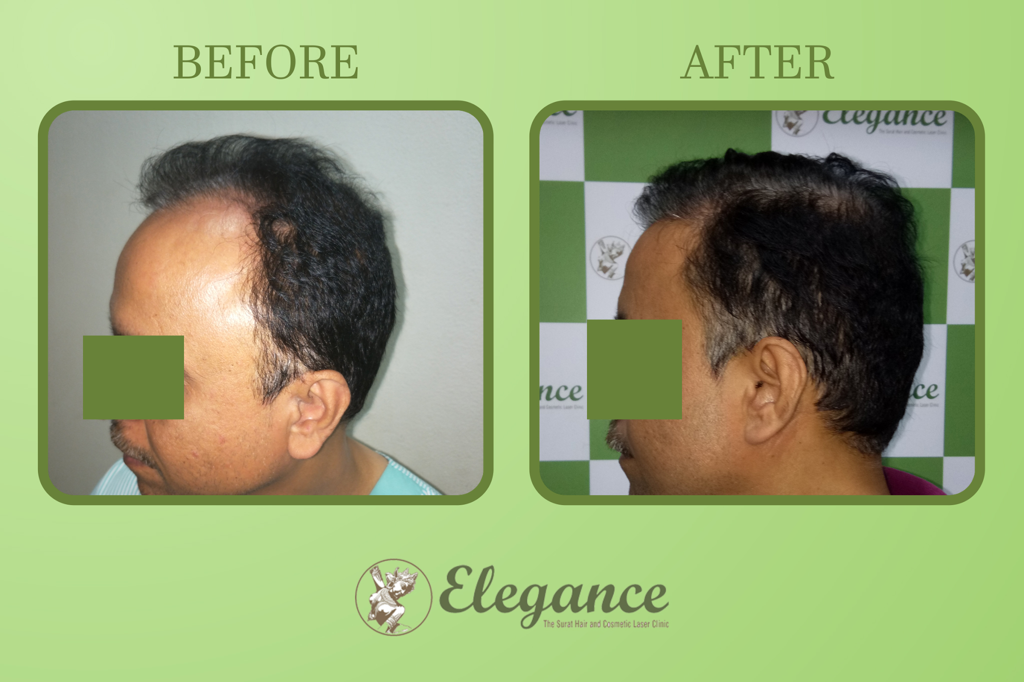 Men Hair Transplant in Varacha, Surat, Gujarat, India