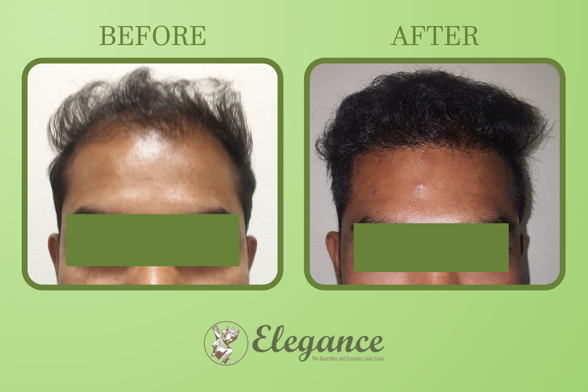 Men Hair Transplant Surgery in Citilight, Surat, Gujarat, India