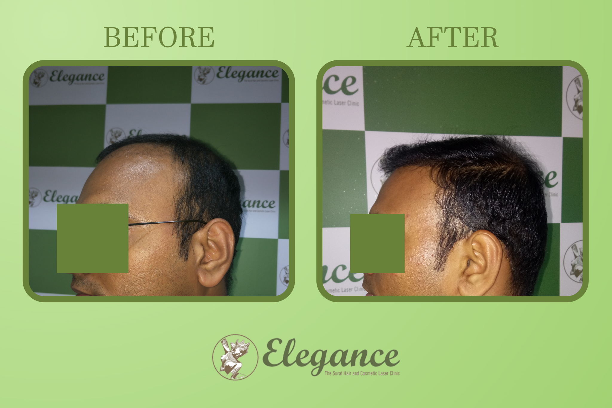 Men Hair Transplant Surgery in Parle Ponit, Surat, Gujarat, India