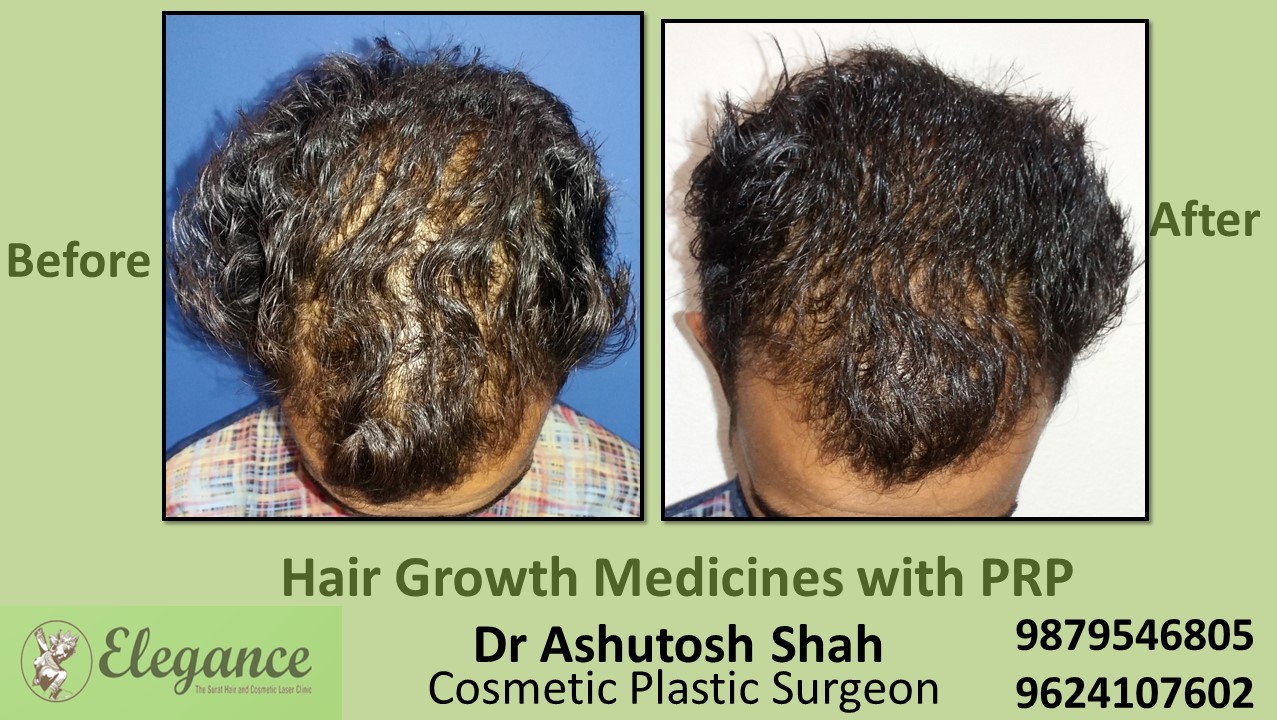 Hair Growth Medicines with PRP Ankleshwar, Gujarat