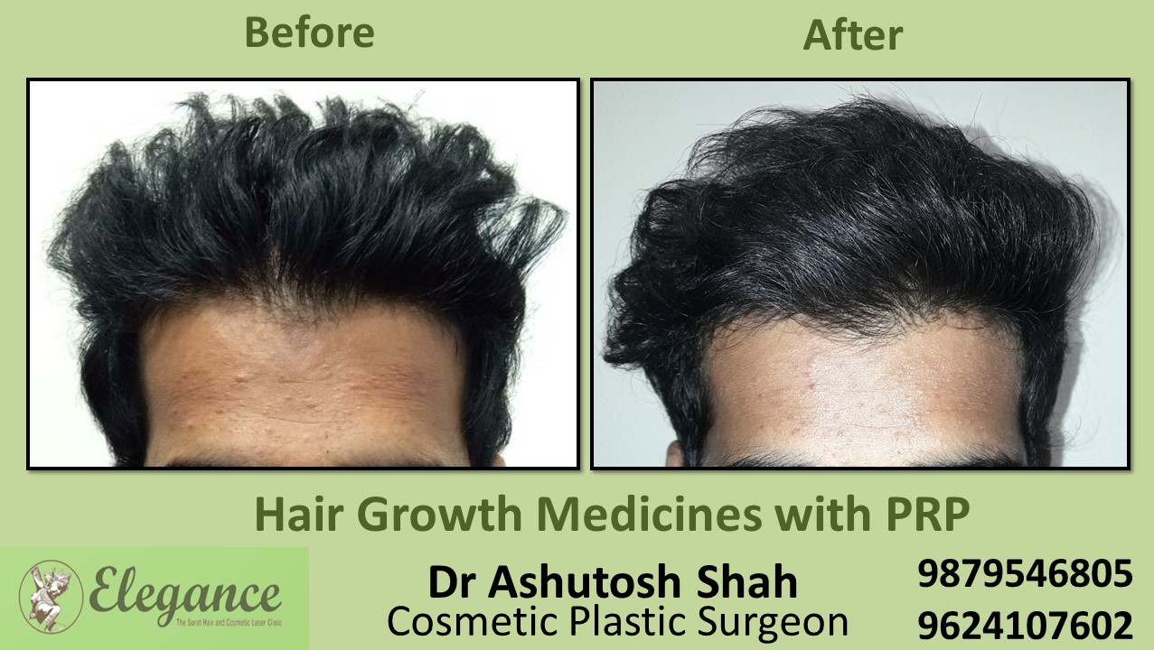 Hair Growth Medicines with PRP Bardoli, Gujarat