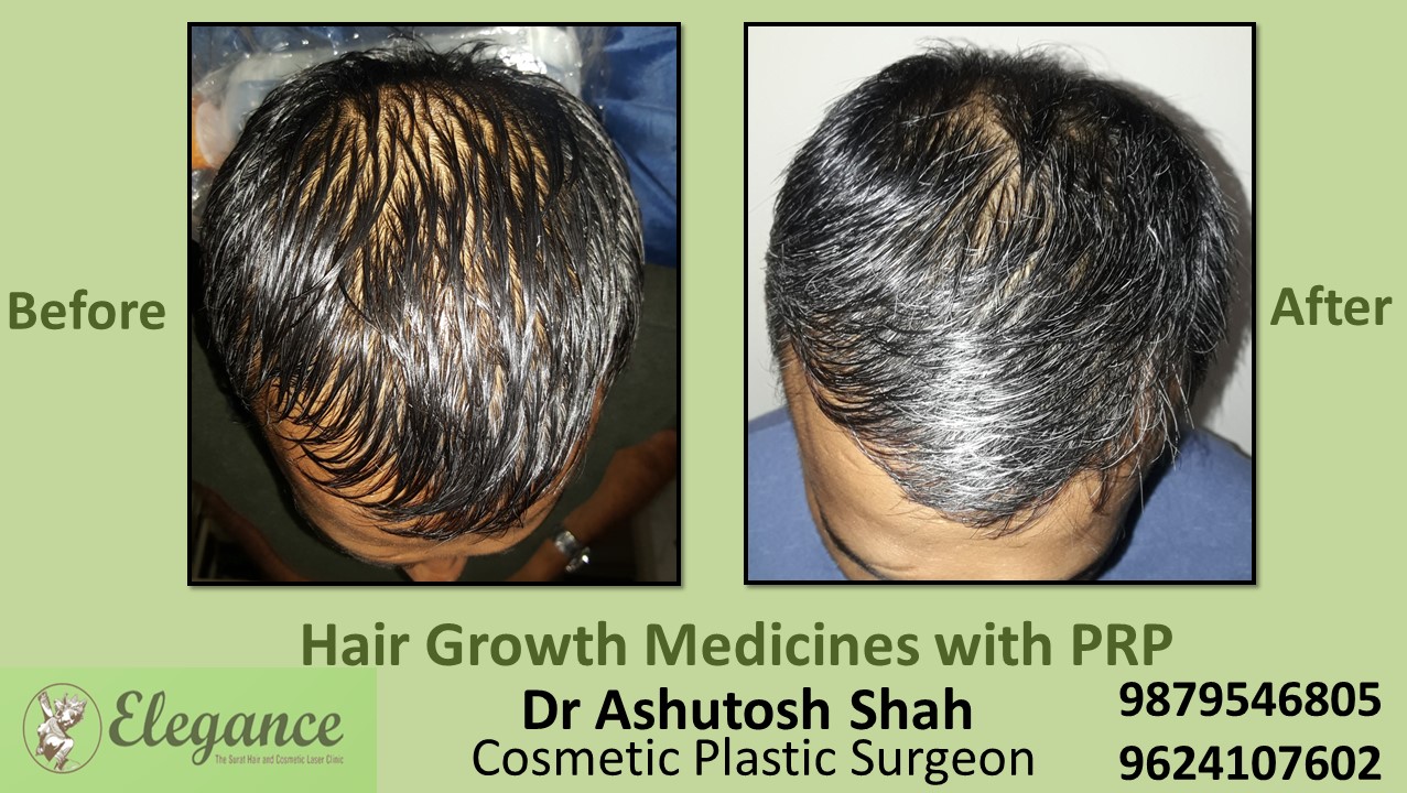 Hair Growth Medicines with PRP Baroda, Gujarat