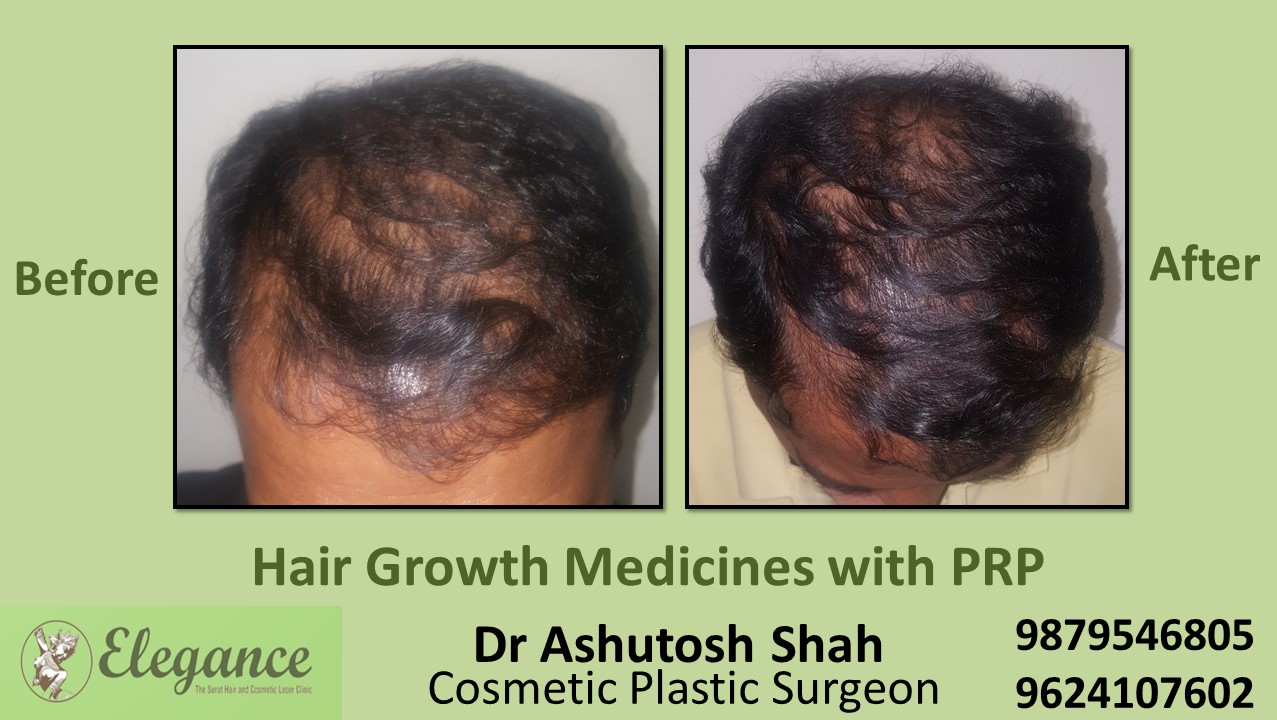 Hair Growth Medicines with PRP Bharuch, Gujarat