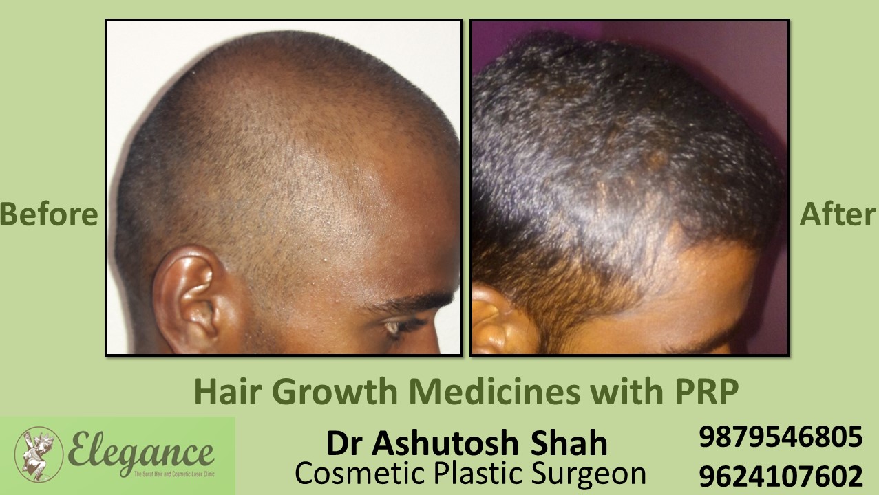 Hair Growth Medicines with PRP Bilimora, Gujarat