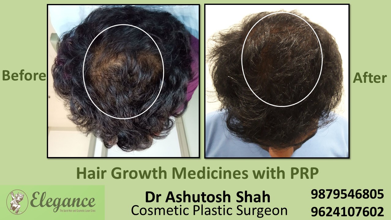 Hair Growth Medicines with PRP Chhota Udaipur, Gujarat
