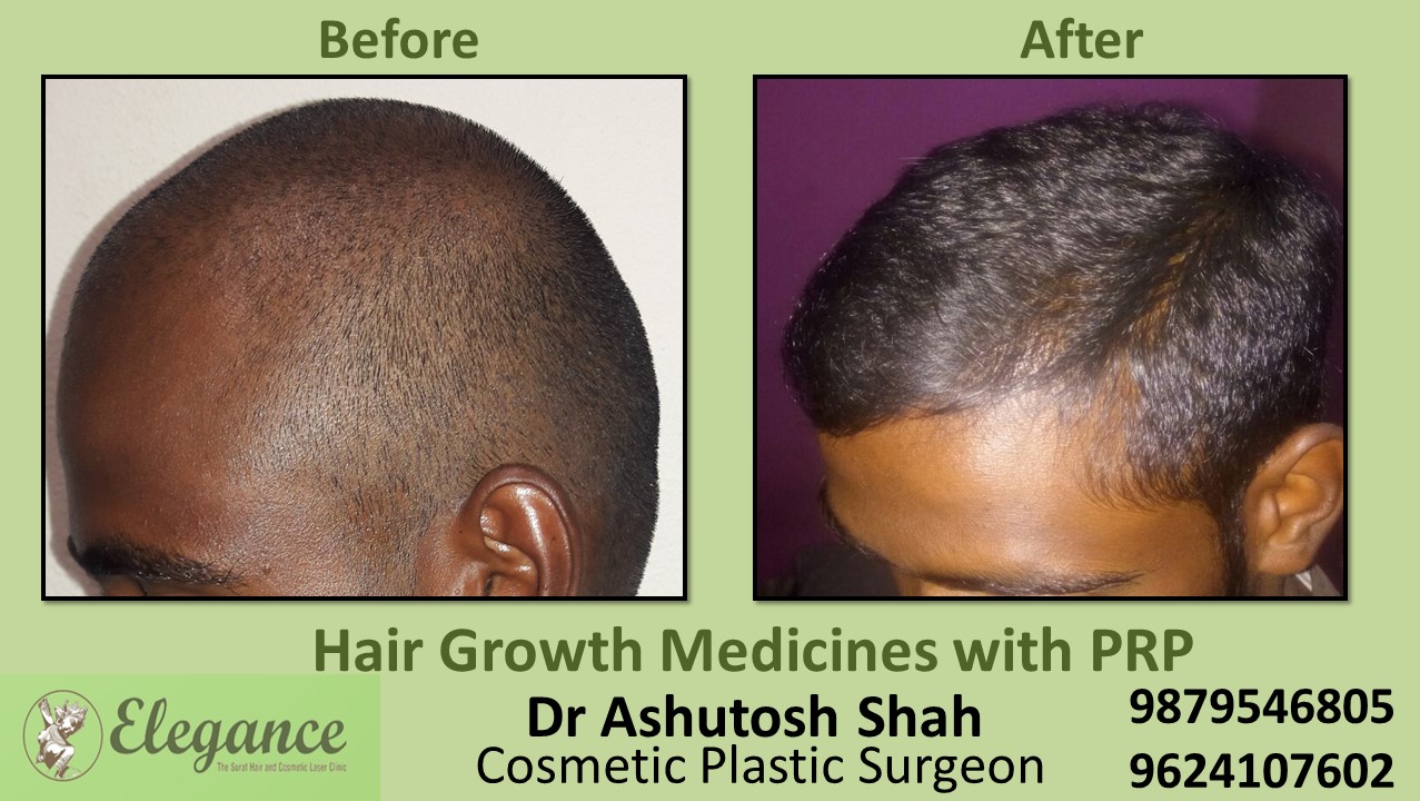 Hair Growth Medicines with PRP Chikhli, Gujarat