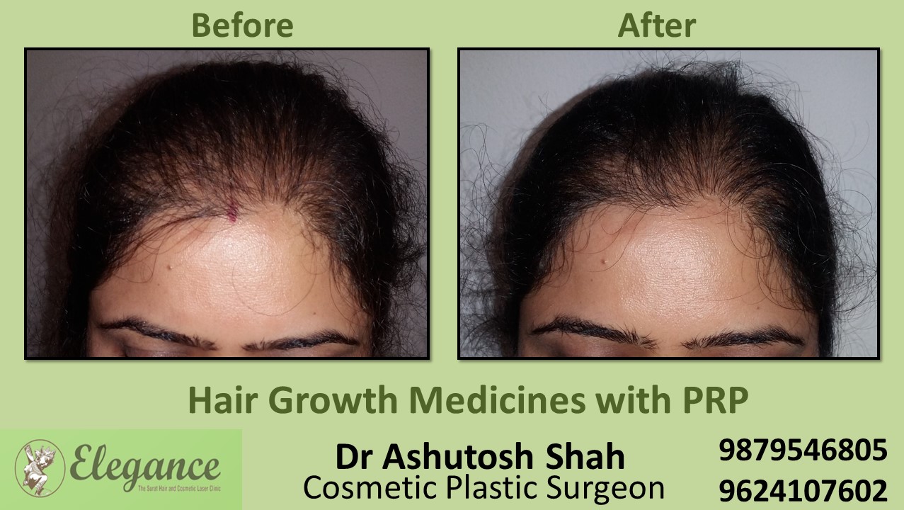 Hair Growth Medicines with PRP Daman, Gujarat