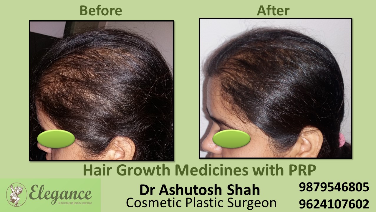 Hair Growth Medicines with PRP kim, Gujarat