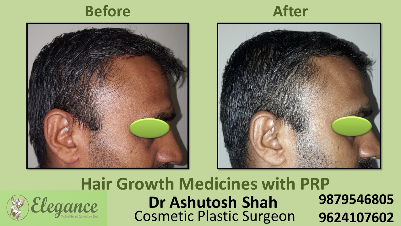 Hair Growth Medicines with PRP Navsari, Gujarat