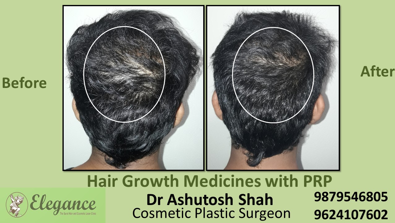 Hair Growth Medicines with PRP Sivasaa, Gujarat