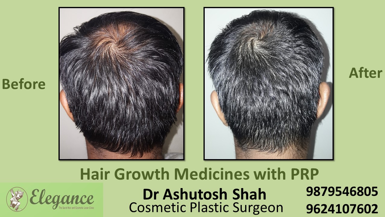 Hair Growth Medicines with PRP Surat