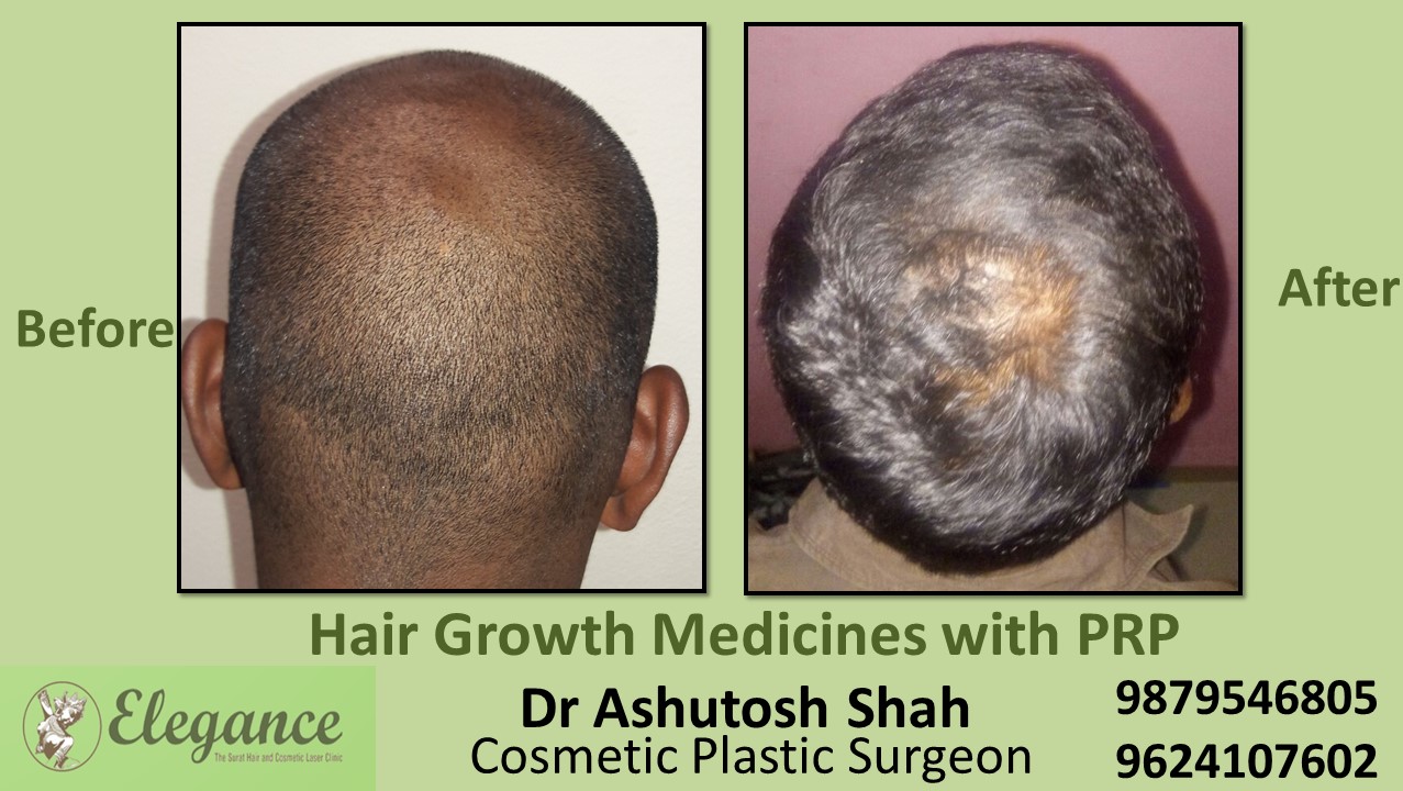 Hair Growth Medicines with PRP Udhana, Surat, Gujarat