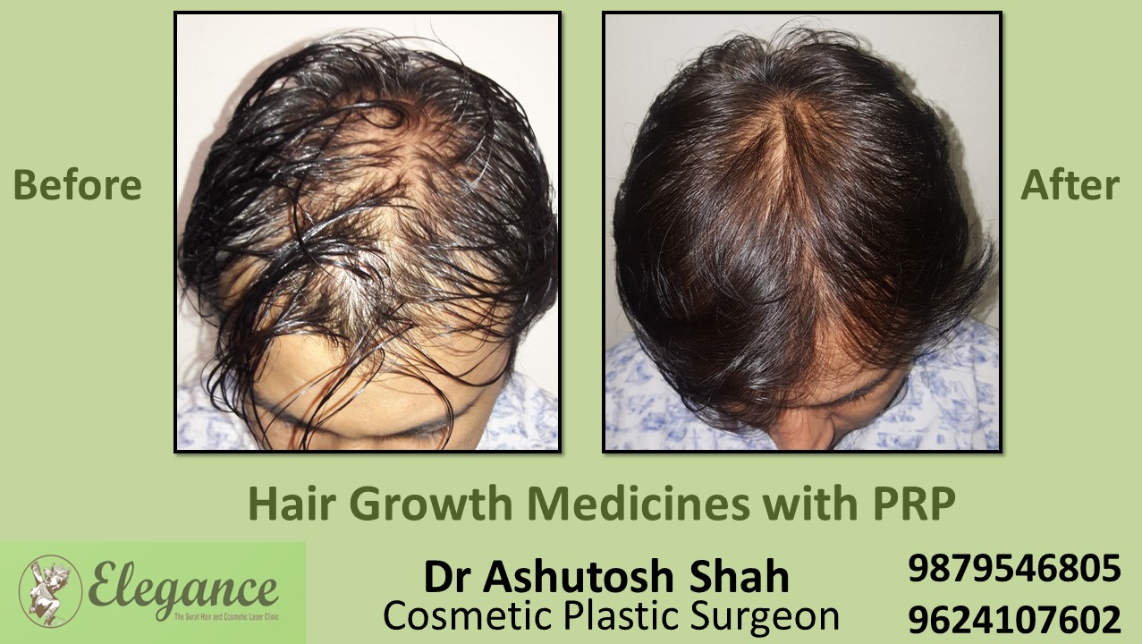 Hair Growth Medicines with PRP Valsad, Gujarat