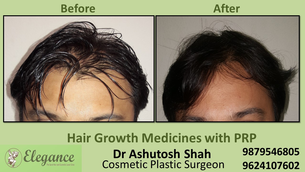 Hair Growth Medicines with PRP Vapi, Gujarat