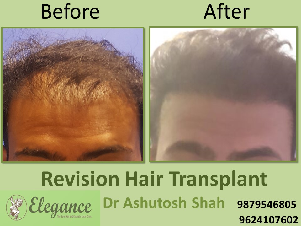 Revision Hair Transplant In Surat, Gujarat, India