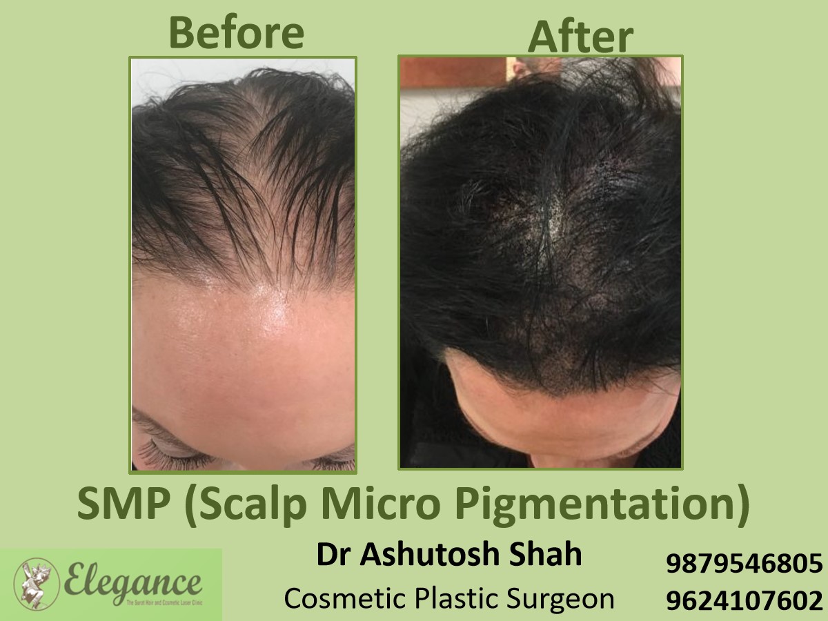 Scalp Micropigmentation Treatment, Hair Baldness in Vesu, Piplod, Surat