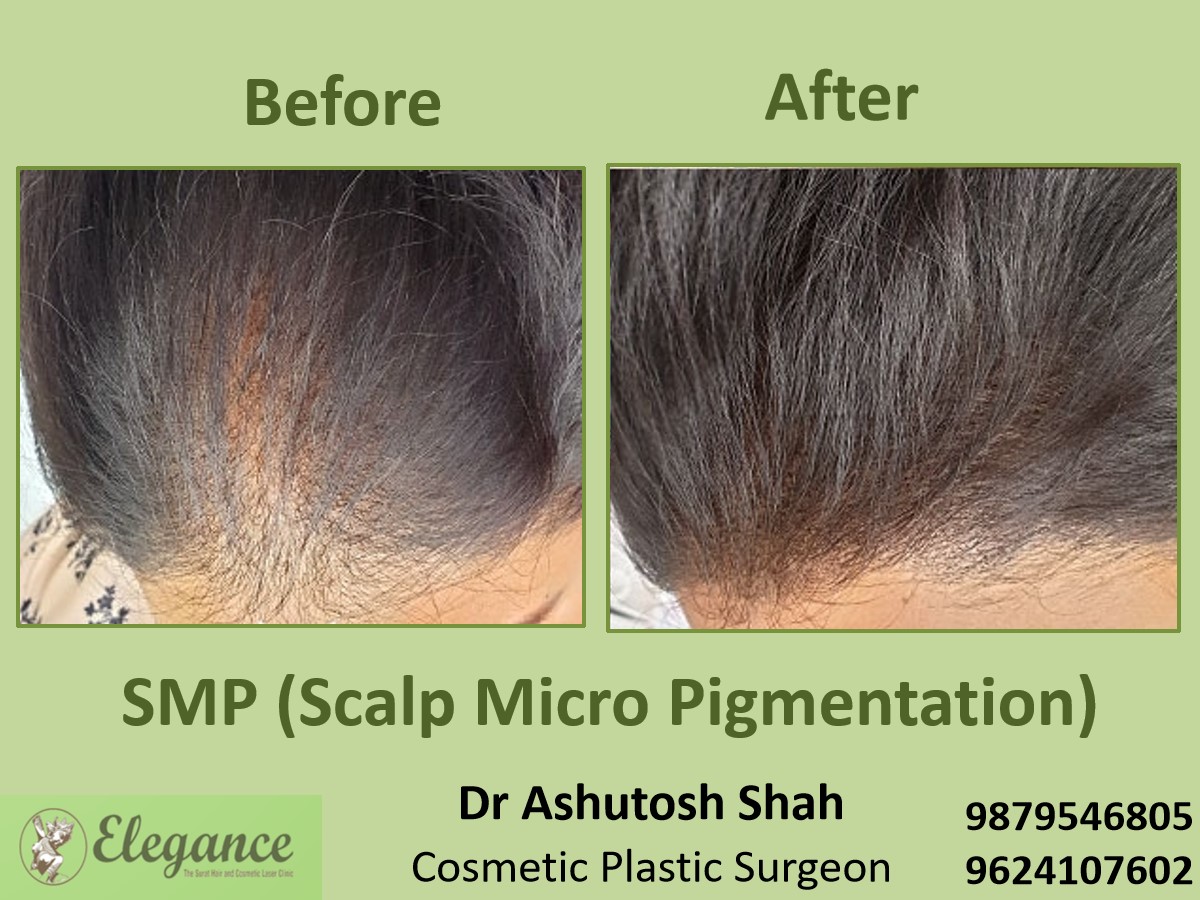 Scalp Micropigmentation Treatment, Hair Baldness in Vesu, Surat