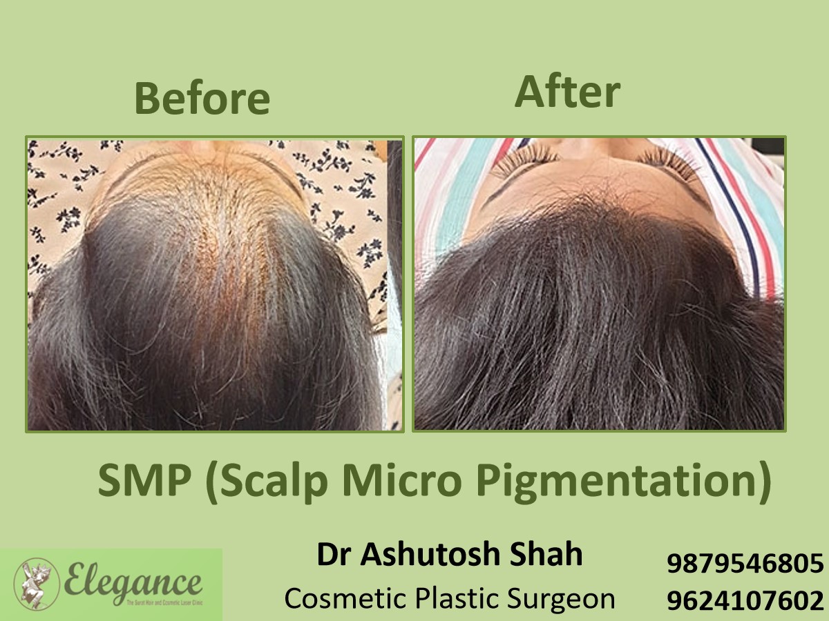 Scalp Micropigmentation Treatment in Vesu, Piplod, Surat