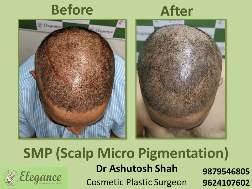 Hair Scalp Micro- Pigmentation, Hair Density Treatment in Vesu, Surat