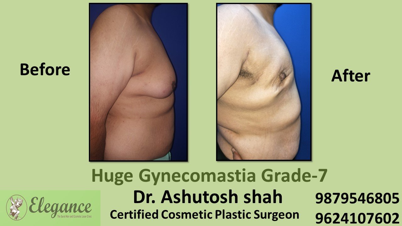 Huge Gynecomastia Grade-7, Selvasa, Gujarat, India.