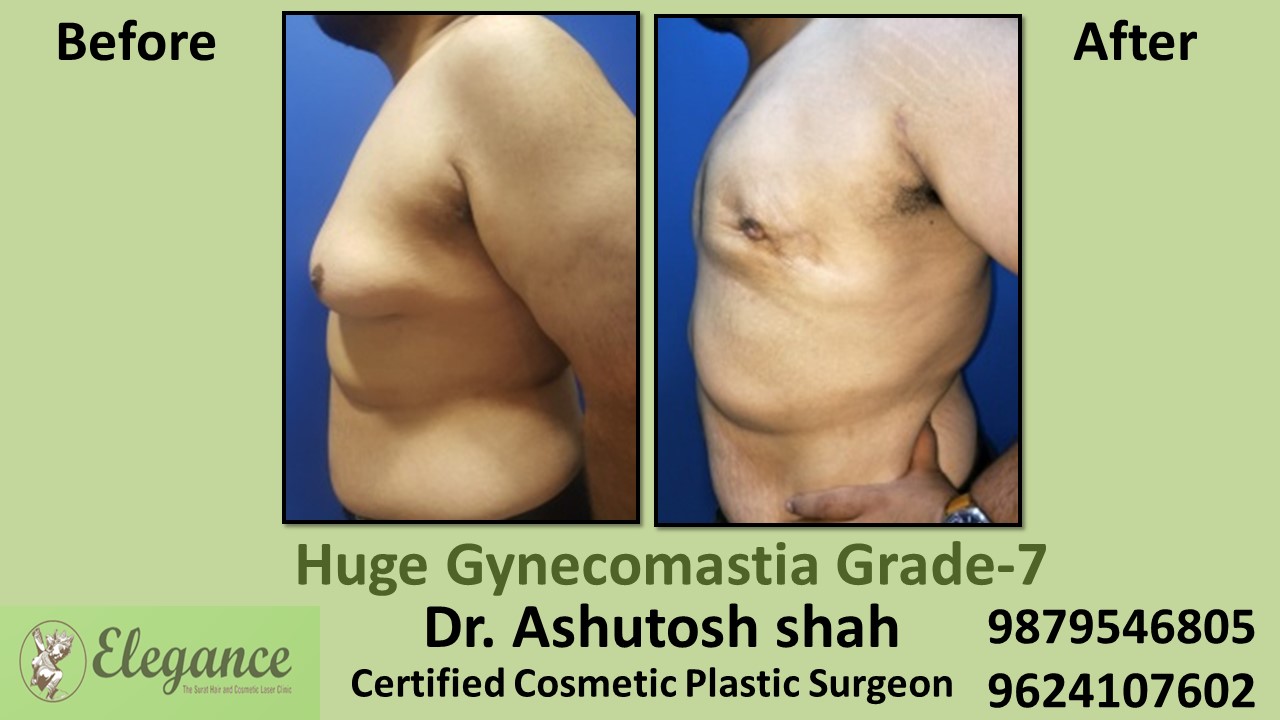 Huge Gynecomastia Grade-7, Surat, Gujarat, India.