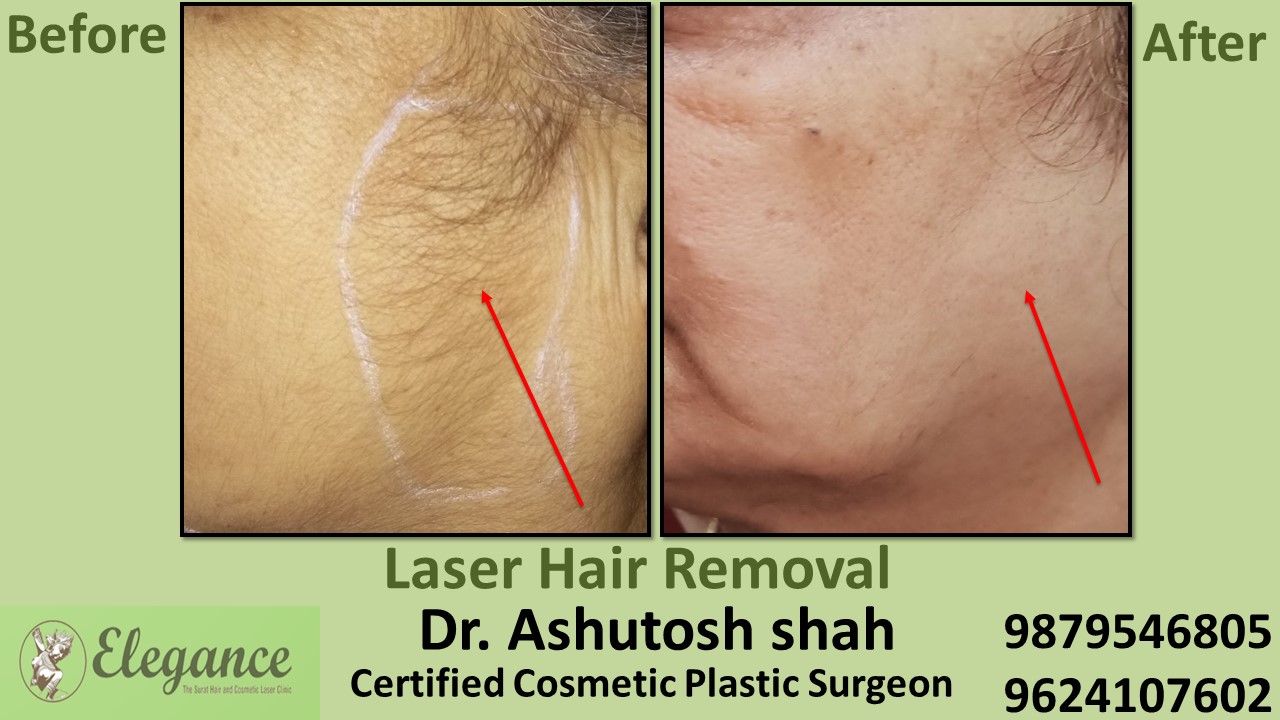 Laser hair Removal