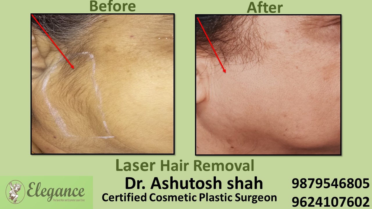 Laser Hair Removal for Female in Surat, Gujarat (India)