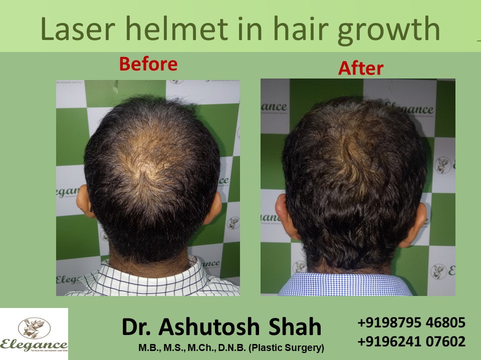 Laser Helmet in Hair Growth Treatment, Surat, Gujarat, India.