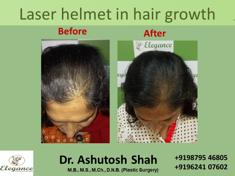 Laser Helmet in Hair Growth Treatment, Vadodara, Gujarat, India.