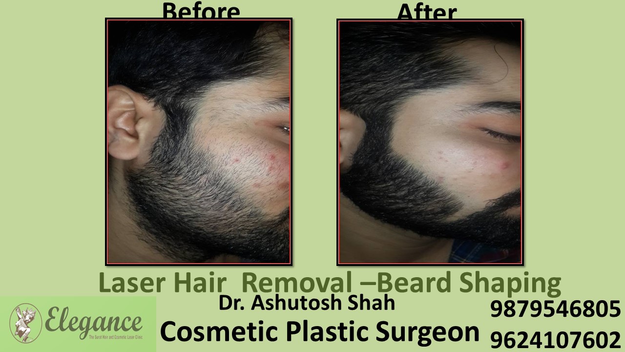 Laser Hair Removal Treatment for Male in Surat, Gujarat (India)