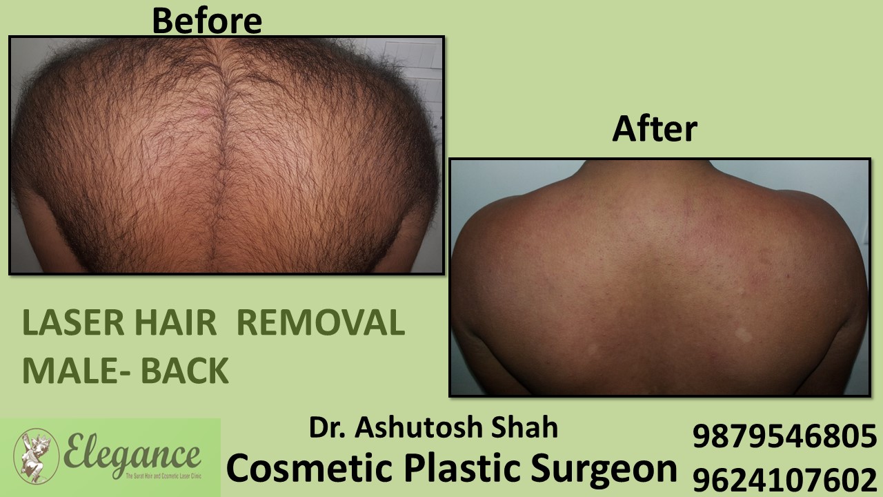 Laser Hair Removal Treatment for Male in Surat, Gujarat (India)