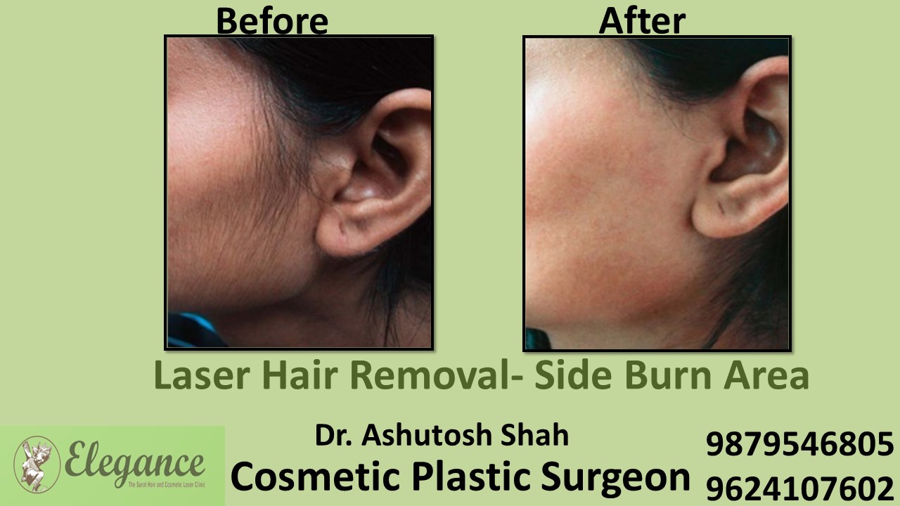 Laser Hair Removal for Female in Surat, Gujarat (India)