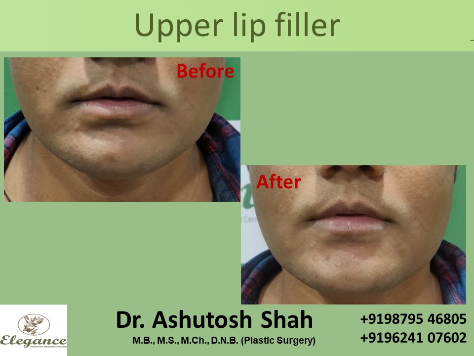 Top Lip Lines Fillers in Surat, Gujarat (India)