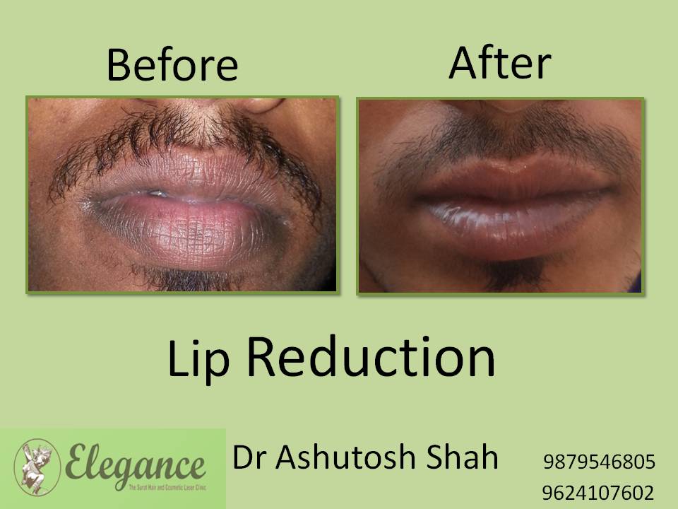 Lip Reduction Surgery, Navsari, Gujarat, India