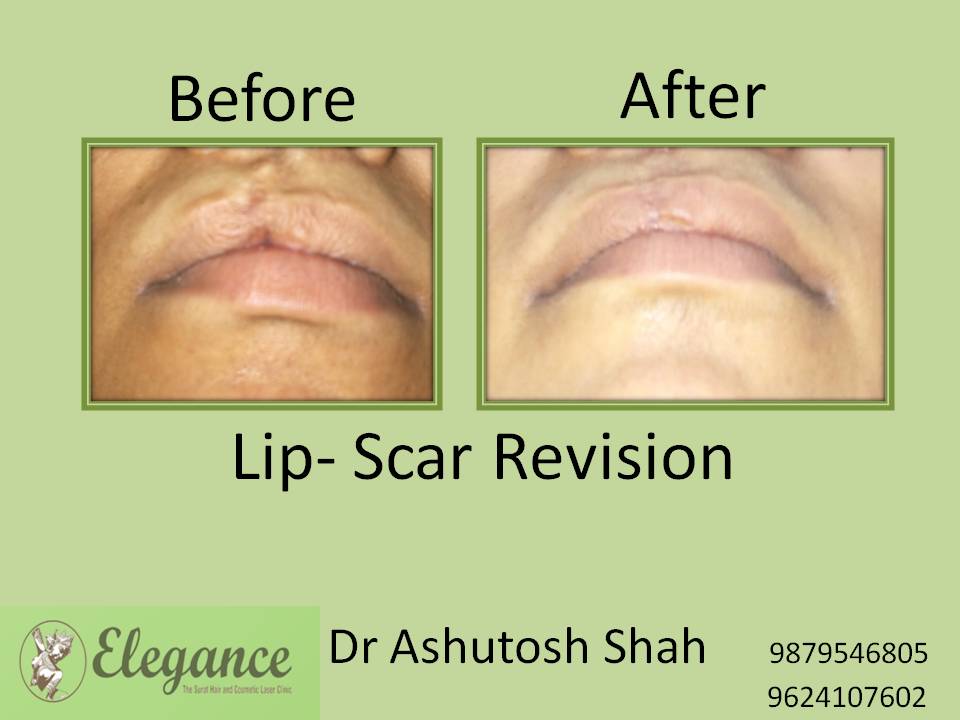 Lip Scar Revision Surgery, Kosamba, Gujarat, India.