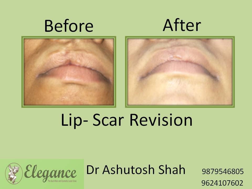 Lip Scar Revision Surgery, Kosamba, Gujarat, India.