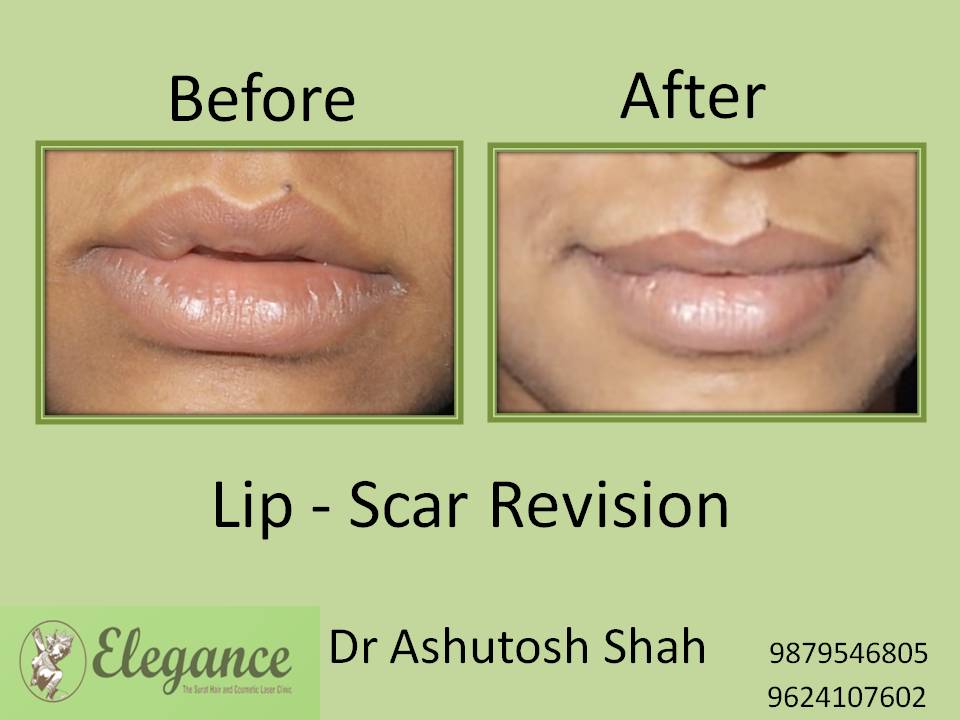 Lip Scar Revision Surgery, Valsad, Gujarat, India.