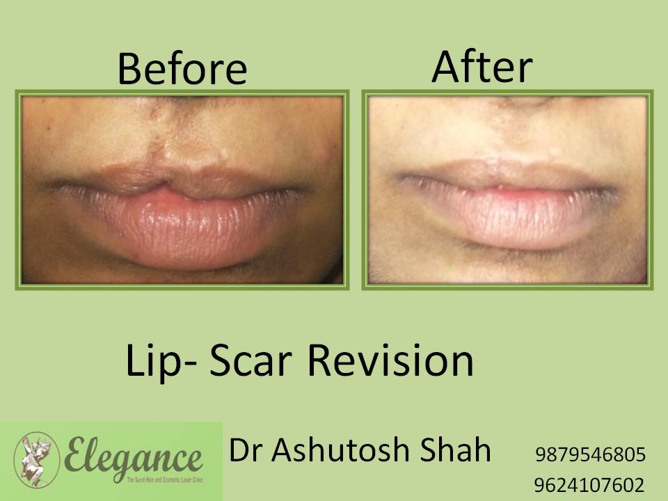 Lip Scar Revision Surgery, Vapi, Gujarat, India.